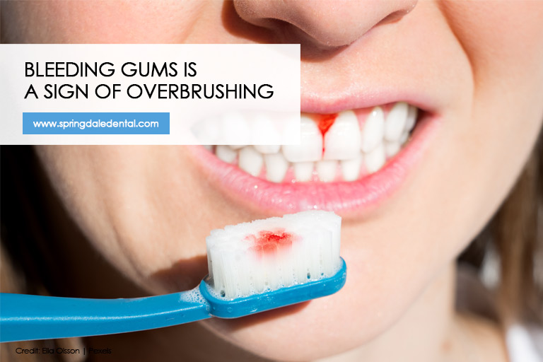 Bleeding gums is a sign of overbrushing